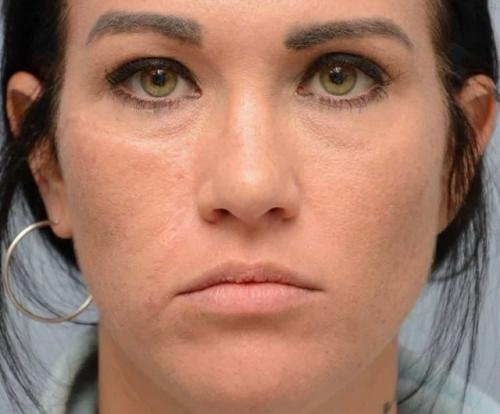 Пациентка обратилась с большим новообразованием на коже лица, которое невозможно было устранить лазером. 01