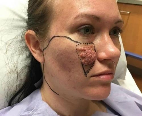 Пациентка обратилась с большим новообразованием на коже лица, которое невозможно было устранить лазером.  