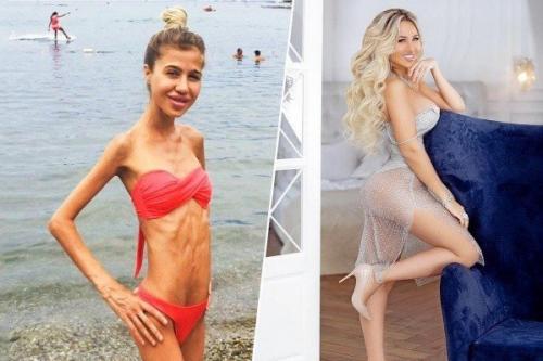 Оказывается маша кохно в юности преодолела сложную и страшную болезнь анорексию. 01