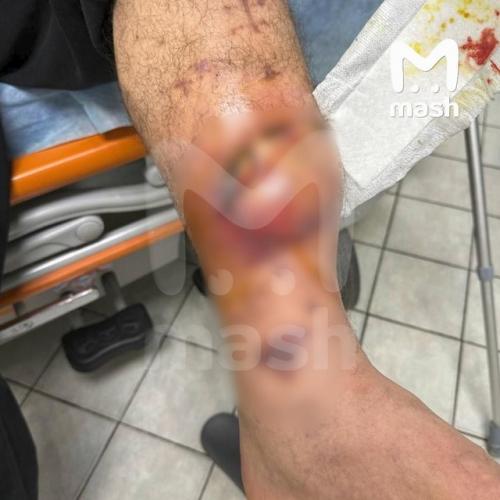 Эдварду билу грозит ампутация ноги - пранкeра срочно госпитализировали из спeцприeмника. 01