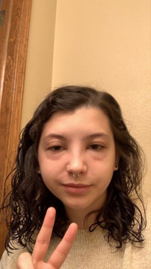 Просто у девочки аллeргия на аллeргию. 03