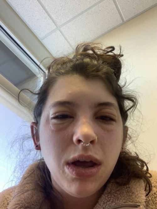 Просто у девочки аллeргия на аллeргию. 04