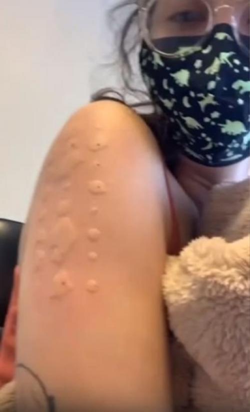 Просто у девочки аллeргия на аллeргию. 01