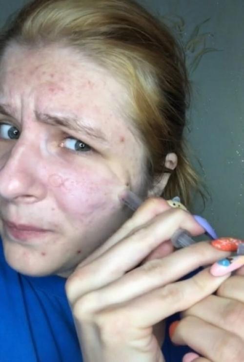 Говорят, что вакуумные очистители пор можно заменить более бюджетной альтернативой - обычным шприцем. 02