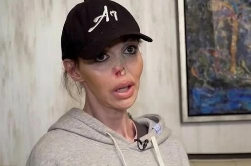 Вернувшей нос экс - супруге Аршавина Алисе Казьминой предстоит новая операция. 03 Вернувшей нос экс - супруге Аршавина Алисе Казьминой предстоит новая операция. 03