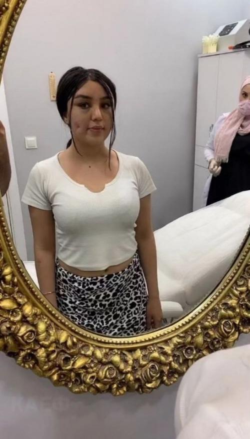 На фото показан процесс, который относится к мини - липосакции лица: жировой комок извлекают через небольшой прокол. 03