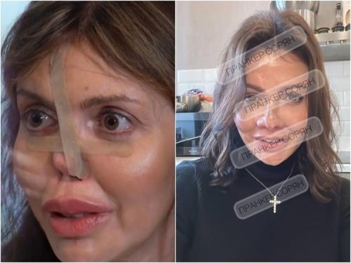 Вернувшей нос экс - супруге Аршавина Алисе Казьминой предстоит новая операция. 02 Вернувшей нос экс - супруге Аршавина Алисе Казьминой предстоит новая операция. 02