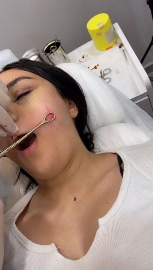 На фото показан процесс, который относится к мини - липосакции лица: жировой комок извлекают через небольшой прокол.  