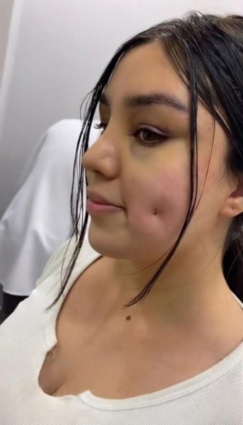 На фото показан процесс, который относится к мини - липосакции лица: жировой комок извлекают через небольшой прокол. 02