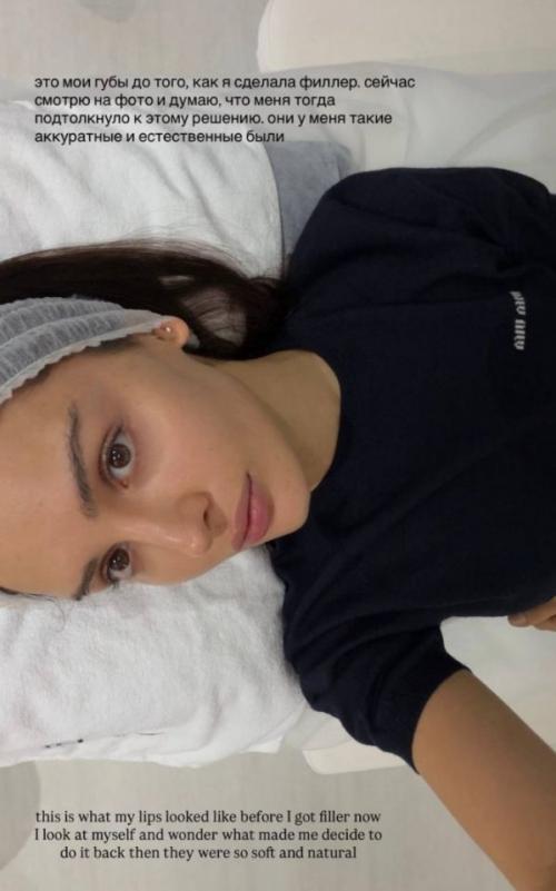 Дина саева рассказала, что приняла решение убрать филлеры из губ. 02