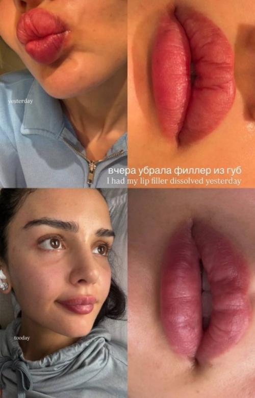 Дина саева рассказала, что приняла решение убрать филлеры из губ. 01