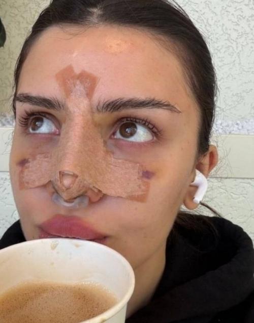 Блогер Дина саева на связь после повторной пластики вышла.  