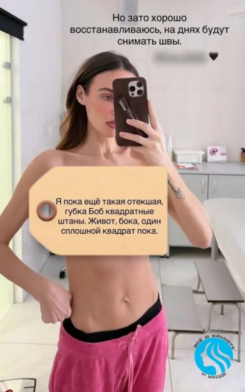 Алена водонаева показала фигуру после повторной пластики. 02