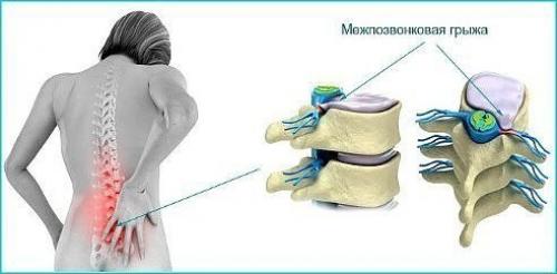 Поясничная грыжа народными способами лечится.

